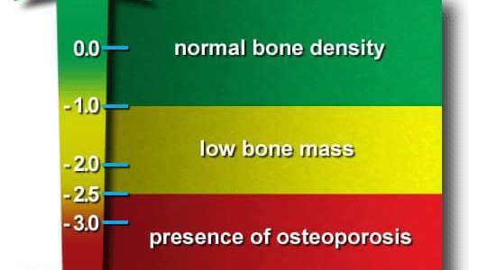 Treatment of osteopenia (“pre-osteoporosis”) prevents osteopororsis