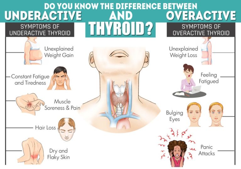 Can Overactive Thyroid Affect Your Eyes