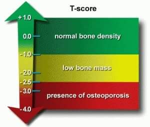 Treatment of osteopenia (“pre-osteoporosis”) prevents osteopororsis
